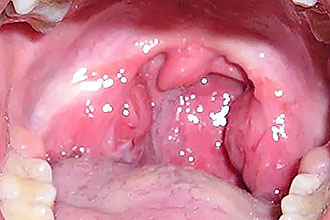 Увеличение миндалин при катаральной ангине Как заподозрить ангину?