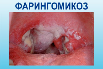 Фарингомикоз Грибковое воспаление глотки