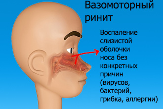 Вазомоторный насморк Вазомоторный ринит