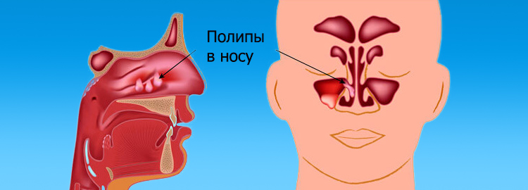 Назальный полип Полип