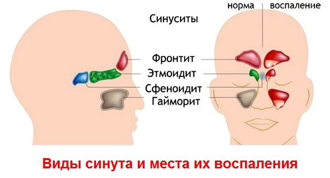 Сопли могут быть симптомом разных видов синусита Что означают жидкие сопли у ребенка